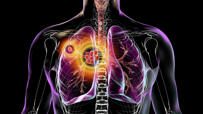 «Мы вернулись в доантибактериальную эпоху»: фтизиатр — о распространённости плохо излечимых форм туберкулёза